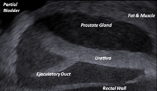 Medical Phantom.Technology from Yezitronix.Prostate phantom - Exact Ultrasound ecogenicity as seen by surgeons in the Operating Room